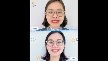 Khớp cắn ngược, răng lệnh - Tú Anh đã vượt qua như thế nào?