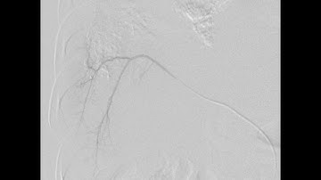 TACE - Trans Arterial Chemoembolization Procedure on Innvolution Cathlab