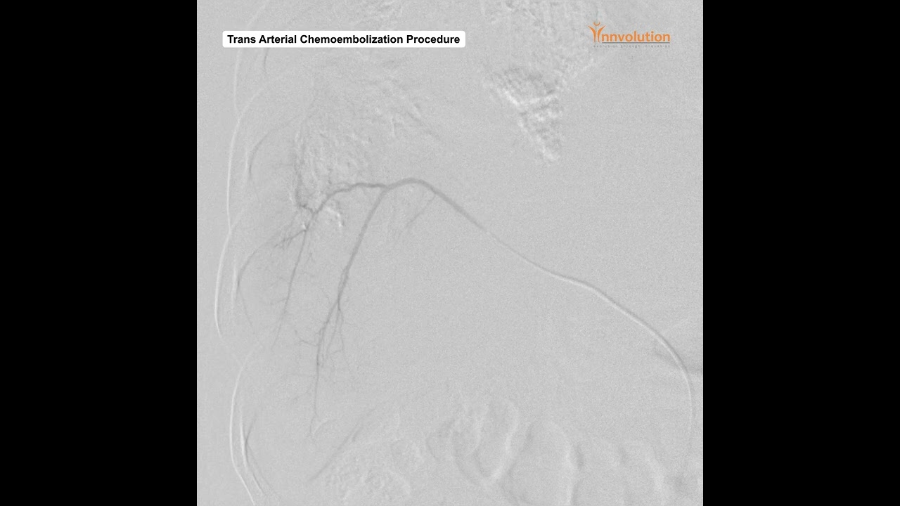 TACE - Trans Arterial Chemoembolization Procedure on Innvolution Cathlab