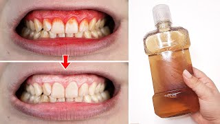 Heal Your Bleeding Gums with This Minty Natural Mouthwash Recipe! 100% effective