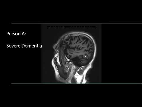 Alzheimer Brain vs Normal Brain on MRI.  Are they different??