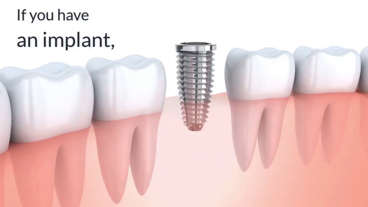 Hydro Floss & Dental Implants