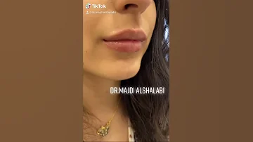 Lips Filler By Dr Majdi Alshalabi حقن فيلر الشفاه بيد د مجدي الشلبي 