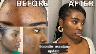 GETTING RID OF ACNE &amp; HYPERPIGMENTATION | 6 MONTHS ACCUTANE UPDATE | ACCUTANE JOURNEY