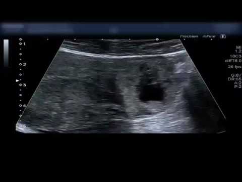 lifebuoy GEU grossesse cornuale interstitielle à 8 SA