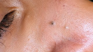 ASMR  Blackheads and Whiteheads Removal | Deep Pore Cleaning Routine