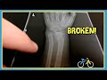 Broken arms are not funawesome