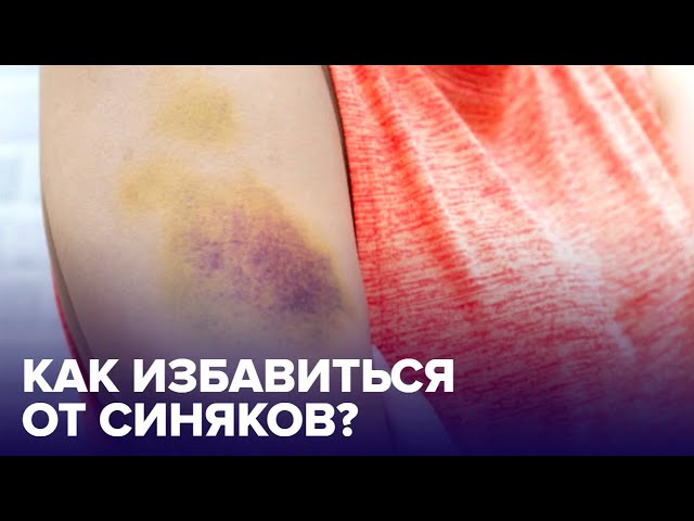 Как быстро УБРАТЬ СИНЯКИ? Самые ЭФФЕКТИВНЫЕ СПОСОБЫ