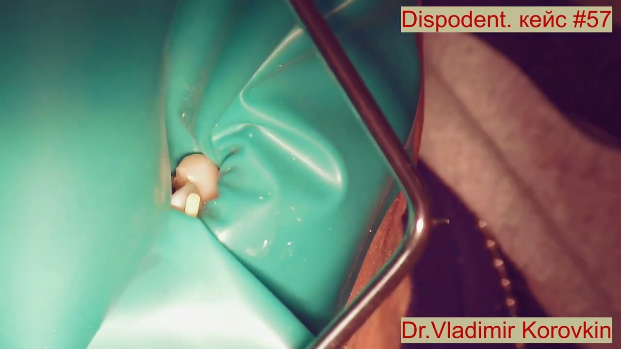Кейс раббердам Dispodent. Для лечения 32,33. Кейс #57.