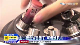 20150226中天新聞 醫美新突破 骨科自體血漿療法促細胞再生