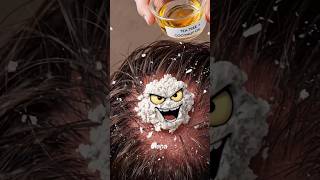 Kill Dandruff Fungus FAST with 2 Ingredients 🥥🌿 #shorts #satisfying