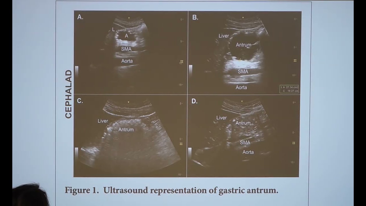 24.10.2025 Ciddi Travma ve Hemorajik Şoktaki Hastada Anestezi yönetimi 