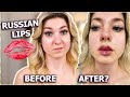 MY RUSSIAN LIP FILLER EXPERIENCE!