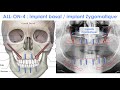 ALL-ON-4 : Implant Basal et Implant Zygomatique