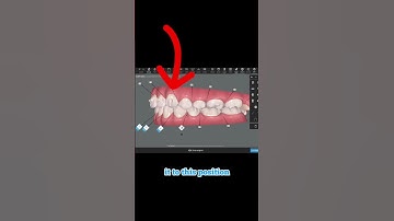 Can Invisalign fix open bite? 2023