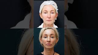Омолодження в ANACOSMA clinic #омолодження #ліфтинг