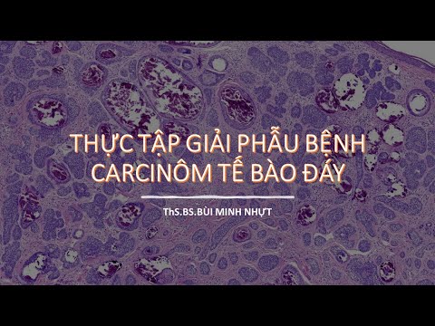 Thực tập GPB: Carcinôm tế bào đáy | Tất tần tật các thông tin về bệnh carcinom đầy đủ nhất