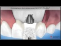 Restauration de la paroi osseuse - Centre Implant Maurice