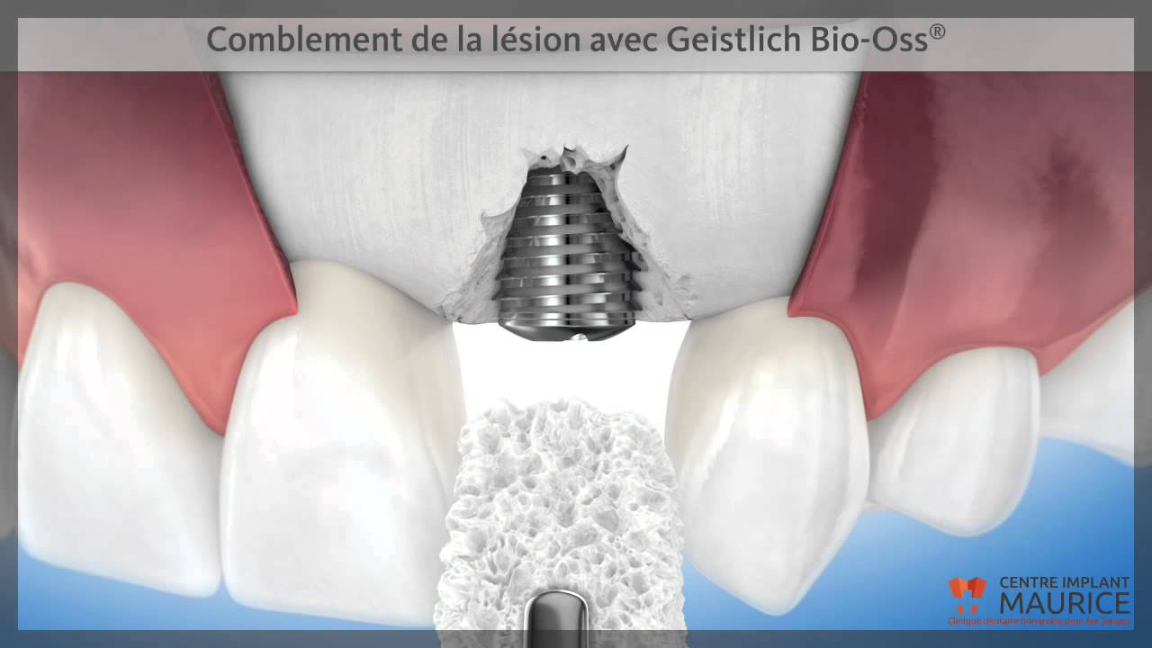 Restauration de la paroi osseuse - Centre Implant Maurice