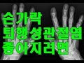 손가락 퇴행성관절염 좋아지려면? Arthritis