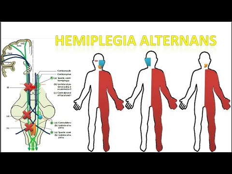 Video: Hemiparesis Vs Hemiplegia: Gejala, Penyebab, Pengobatan