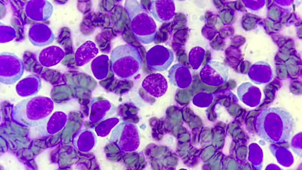 Histiocytoma cytology YouTube Histiocytoma cytology YouTube