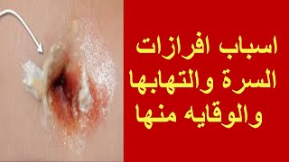 اسباب افرازات السرة والتهابها والوقايه منها