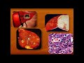 Патологическая анатомия-2 - Лекция 4 (стом. фак) - Болезни печени и почек