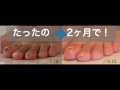 巻き爪など爪の改善例