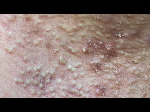 Acne Treatment For "Hung" (P6) | Điều Trị Mụn Cho Hùng (P6) =  SacDepSpa#193