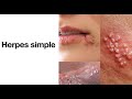 Herpes simple - ¿Qué es el herpes? - Herpes labial, herpes genital, herpes oral.