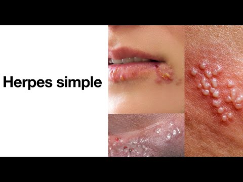 Herpes simple - ¿Qué es el herpes? - Herpes labial, herpes genital, herpes oral.