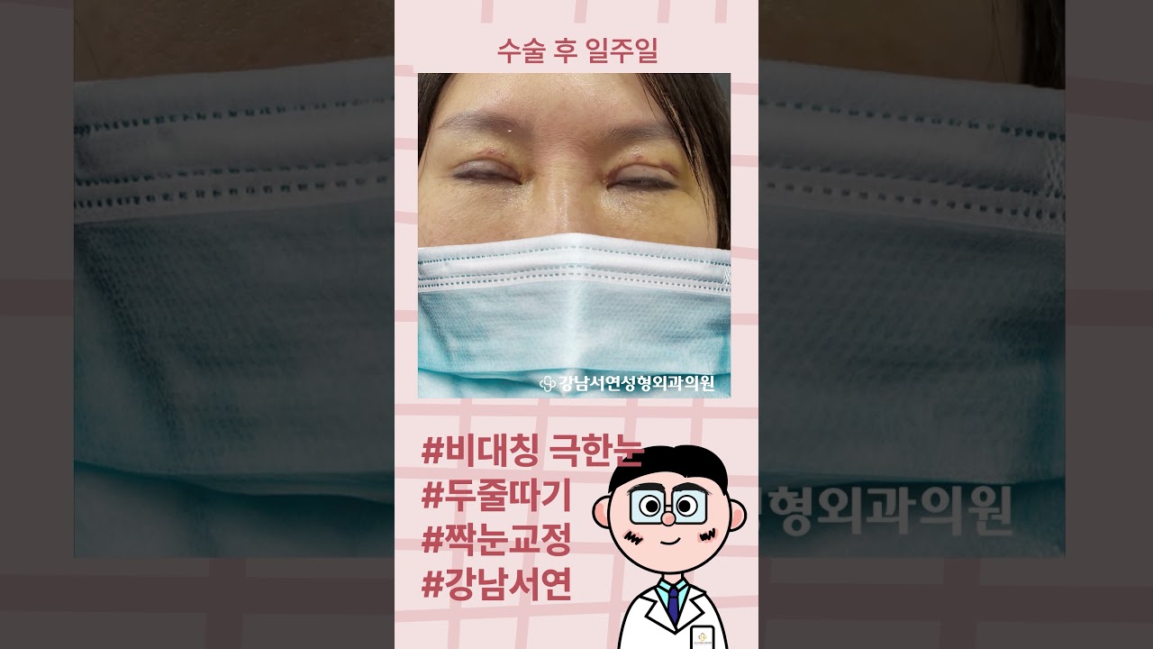 [Ганнам Соён гоо сайхны мэс заслын эмнэлэг] Хүнд хэлбэрийн тэгш бус нүд, давхар зовхины нарийн аргаар тэгш бус нүдийг засах"

Let's re-evaluate "극한눈 두줄따기 짝눈교정".
*