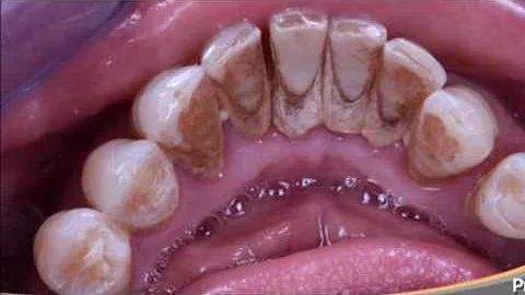 ¿Qué aspecto tiene la periodontitis crónica?