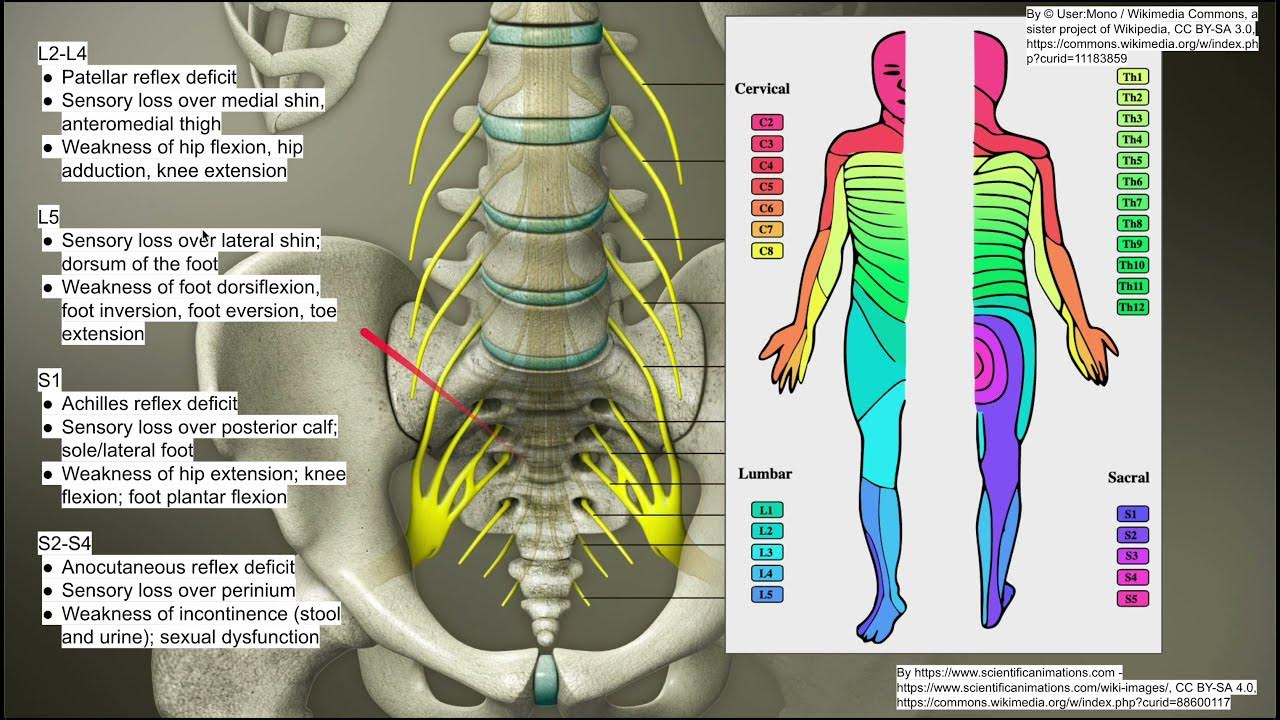 Lumbosacral Radiculopathy Icd 10 M54.16