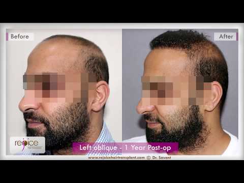 Hair Transplant
