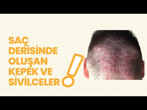 Saç Derisinde Oluşan Sivilce Ve Kepek Nedenleri - Sivilce ve Kepek Tedavisi