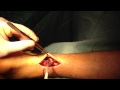 Rparation tendon dachille dr cazal julienmonaco nice