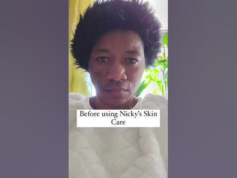 Treat uneven skin tone in 4 weeks #hyperpigmentation #blackskin #