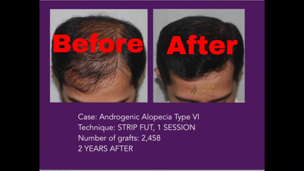 Hair Transplant Patient Testimonial Hair Growth 2 years after 1st