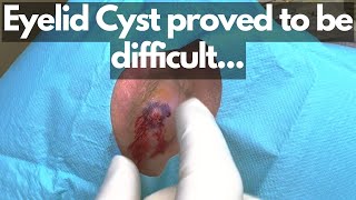 Cyst on his EYELID?!?! | CONTOUR DERMATOLOGY
