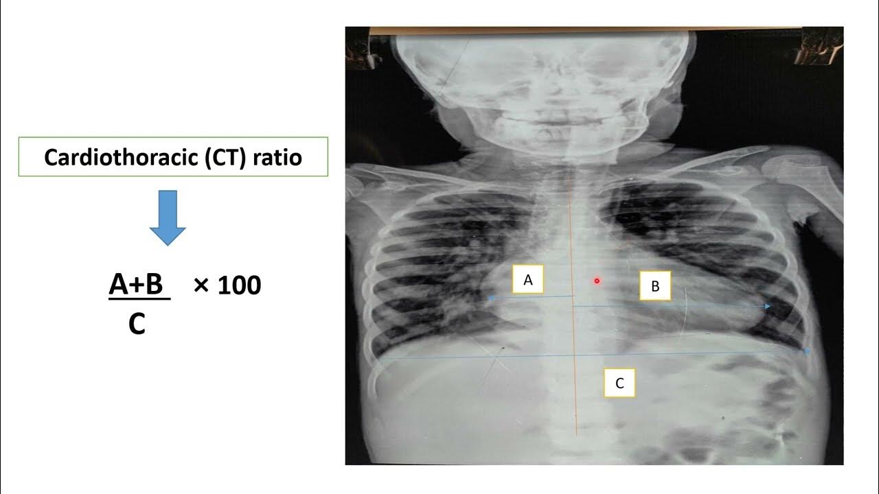 Reading Chest XRay Pediatrics YouTube