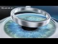 Prk  la chirurgie des yeux au laser 1987