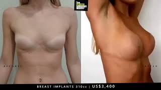 US$3,400 Breast Augmentation | ✔️www.TopPlasticSurgeonsMexico.com