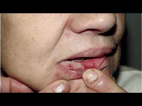 Wideo: Pemphigus - Leczenie I Zapobieganie Chorobie