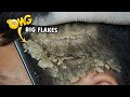 Psoriasis Dandruff Scratching Big Flakes #640