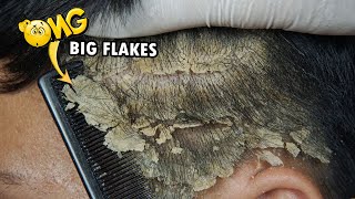 Psoriasis Dandruff Scratching Big Flakes #640