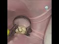 vertical condensation warm obturation الحقن الحراري للكوتا و التكثيف العمودي mp3