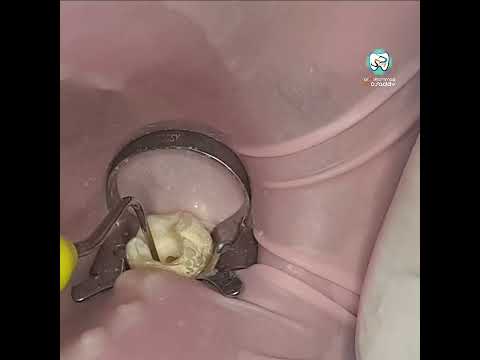     الحقن الحراري للكوتا و التكثيف العمودي