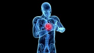 What is Cardiovascular Occlusion